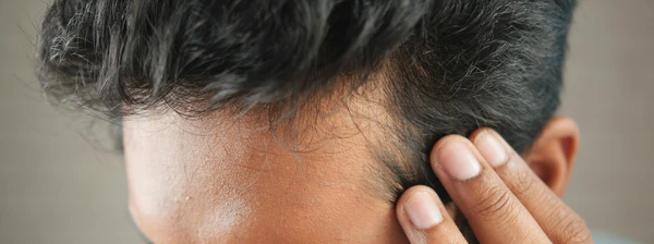 DHI direct hair implantation technique at a premium clinic in Turkey