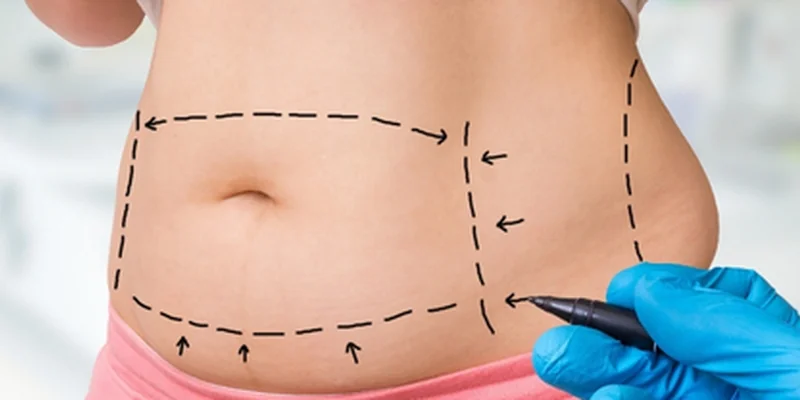 Liposuction body contouring treatment results in Antalya Turkey