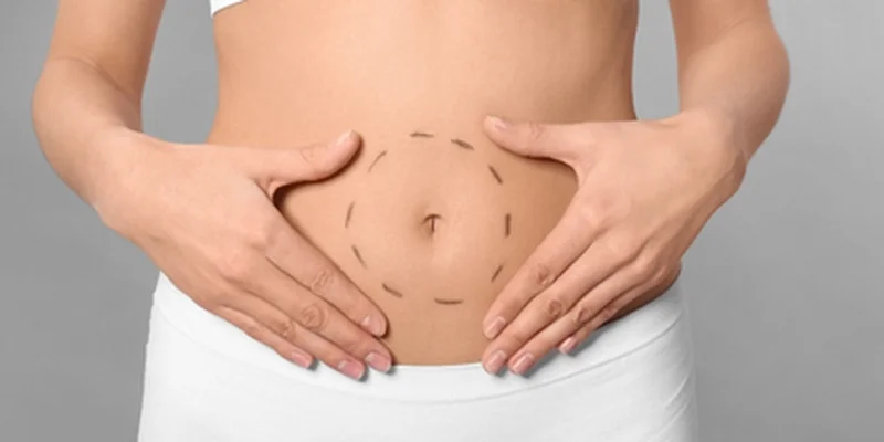 Flat toned abdomen after tummy tuck abdominoplasty in Antalya Turkey